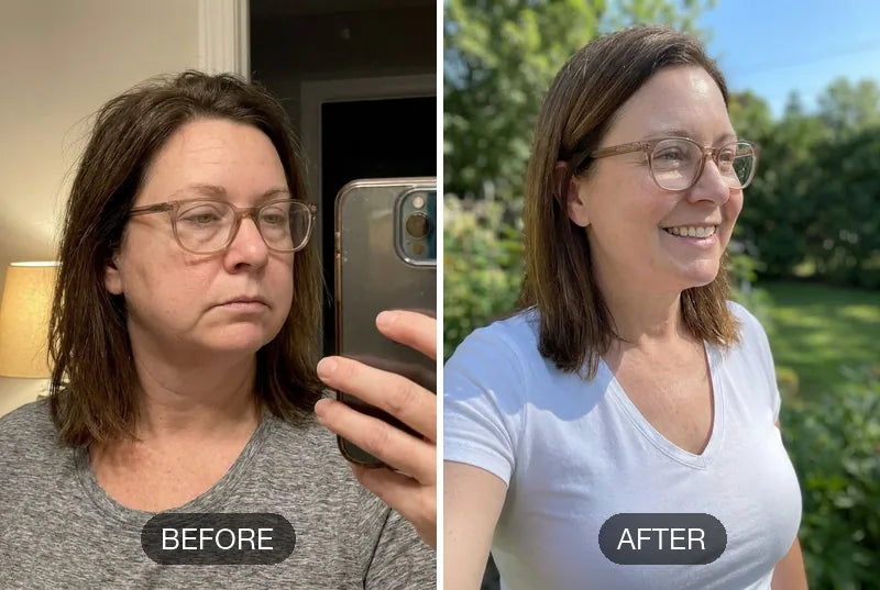 Before and after comparison of a woman's face with 'Before' on the left and 'After' on the right.